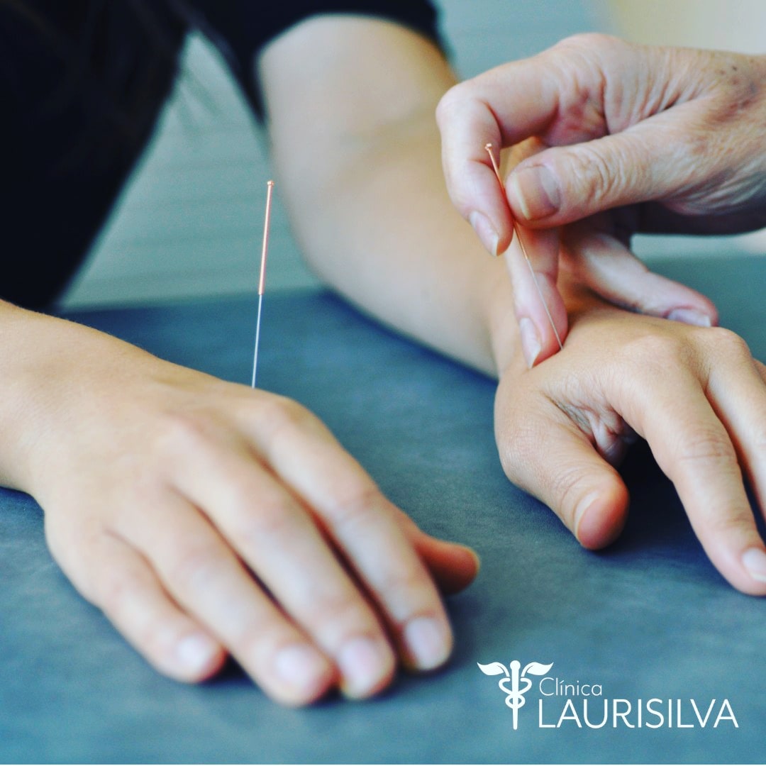 Fotografía de manos recibiendo acupuntura en la clínica Laurisilva